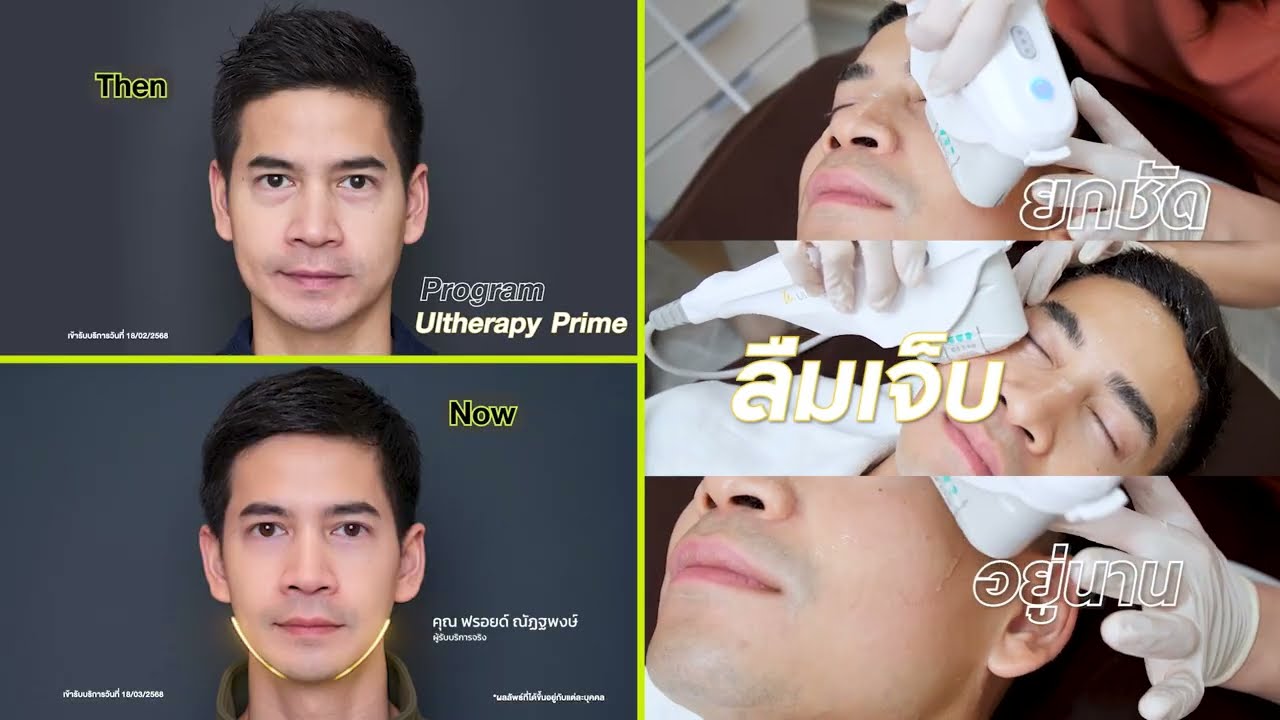 รีวิว Ulthera Prime คุณฟรอยด์ ยกกระชับกรอบหน้าคมชัด