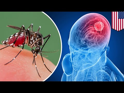 Brain cancer: Zika virus may be the key to treating deadly Glioblastoma brain cancer - TomoNews