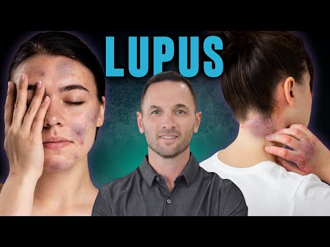 ¿Morados en la piel? ATENCIÓN 🚨 Son SINTOMAS de LUPUS