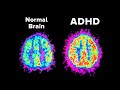 Why Does Your ADHD Make Things So Hard