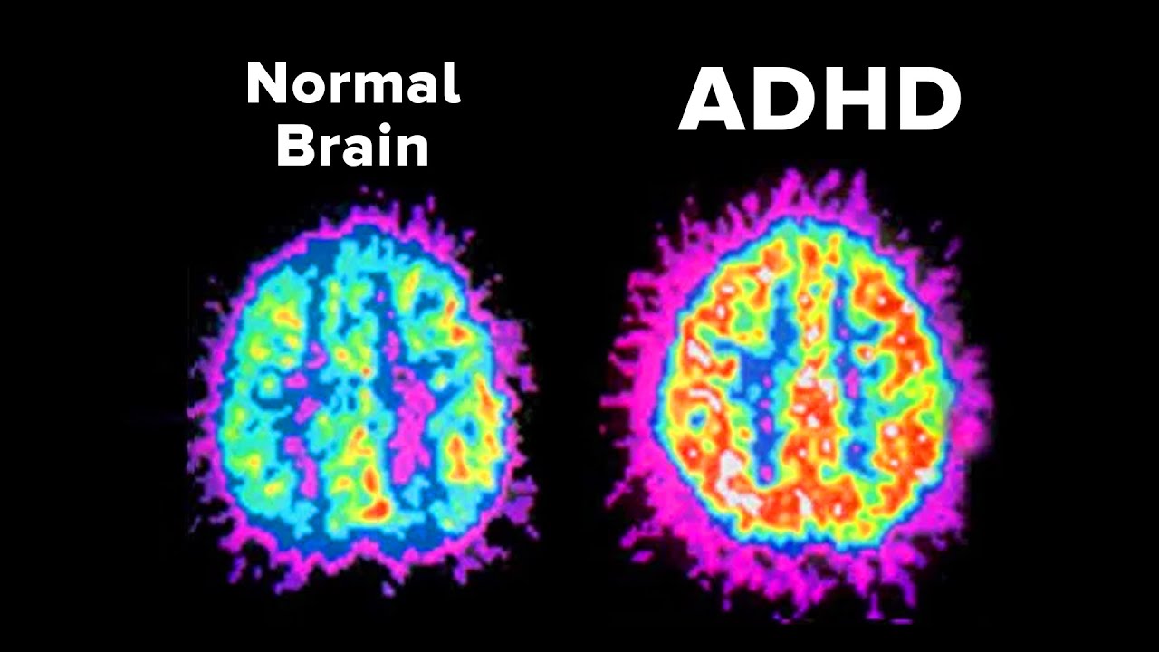 Why Does Your ADHD Make Things So Hard?
