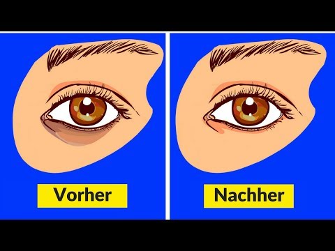 Ob man die Schuppenflechte der Hände heilen kann Die Schuppenflechte auf dem Kopf der Honig