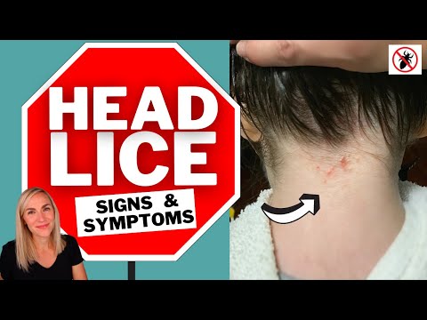 Lice Signs and Symptoms Video Tutorial