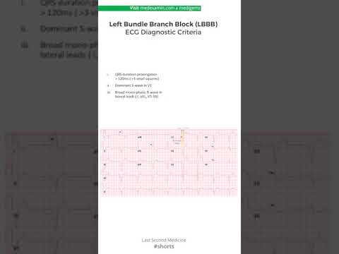 Left Bundle Branch Block (LBBB) ECG Criteria #shorts
