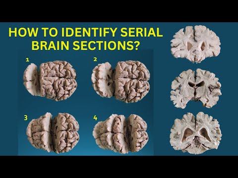 3D Sections of Brain | Coronal & Horizontal Sections | Anatomy Decoded
