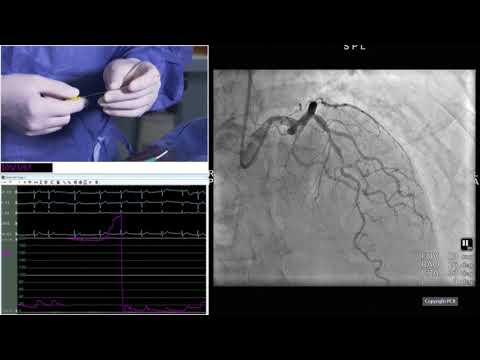 Transradial approach and complex PCI
