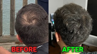 how i reversed balding