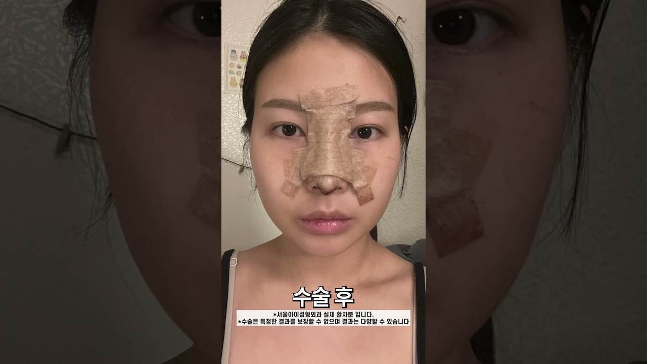 자려한 코 = 서울아이 #코성형