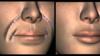 Preenchimento Facial, Antes e Depois do tratamento de bigode chinês