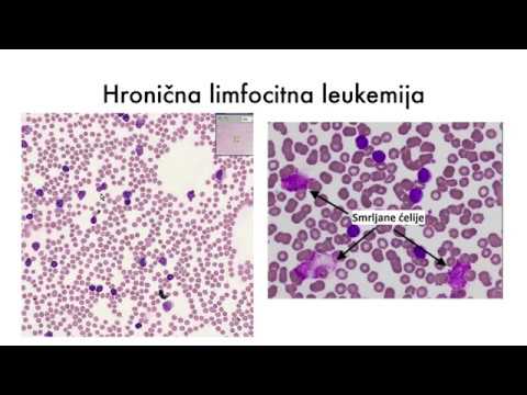 Hronicna Leukemija - sve sto treba da znate (patologija + patofiza)
