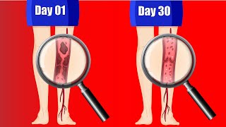 4 Exercises to Reduce Spider and Varicose Veins