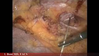 TPEA Lifter - Temporary Hernia Mesh Fixation