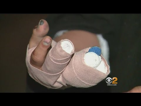 Teen Injured In Hit-And-Run Crash Risks Fingers Being Amputated