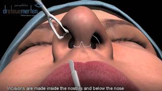 Rhinoplasty Nose Surgery Animation - Dr. Steve Merten in Sydney, Australia