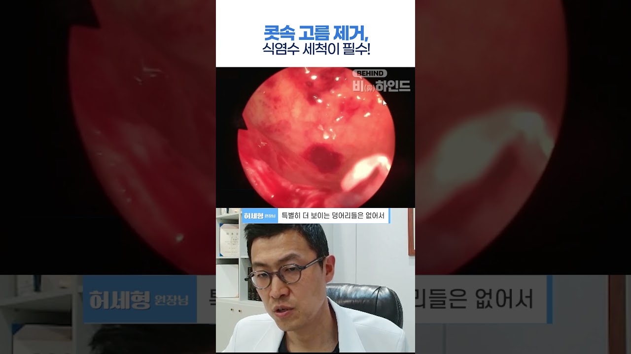 콧속 고름 제거, 식염수 세척이 필수!