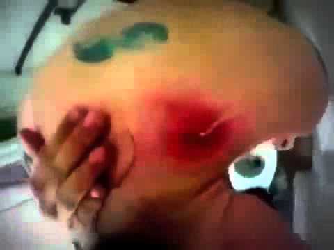 Painful neck pimple, cyst popping 2014 kopia