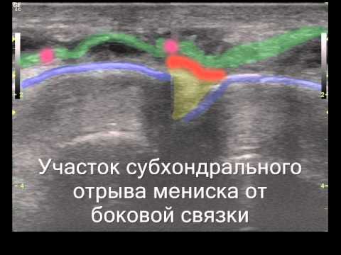 Эндопротезирование суставов в туле Саднящие суставы