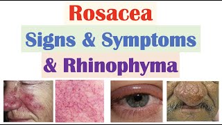 Rosacea Signs & Symptoms (Including Ocular Rosacea & Rhinophyma)