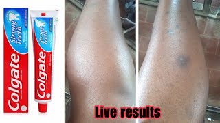 HOW TO:REMOVE DARK SPOTS FROM YOUR LEGS FAST,100% WORKING