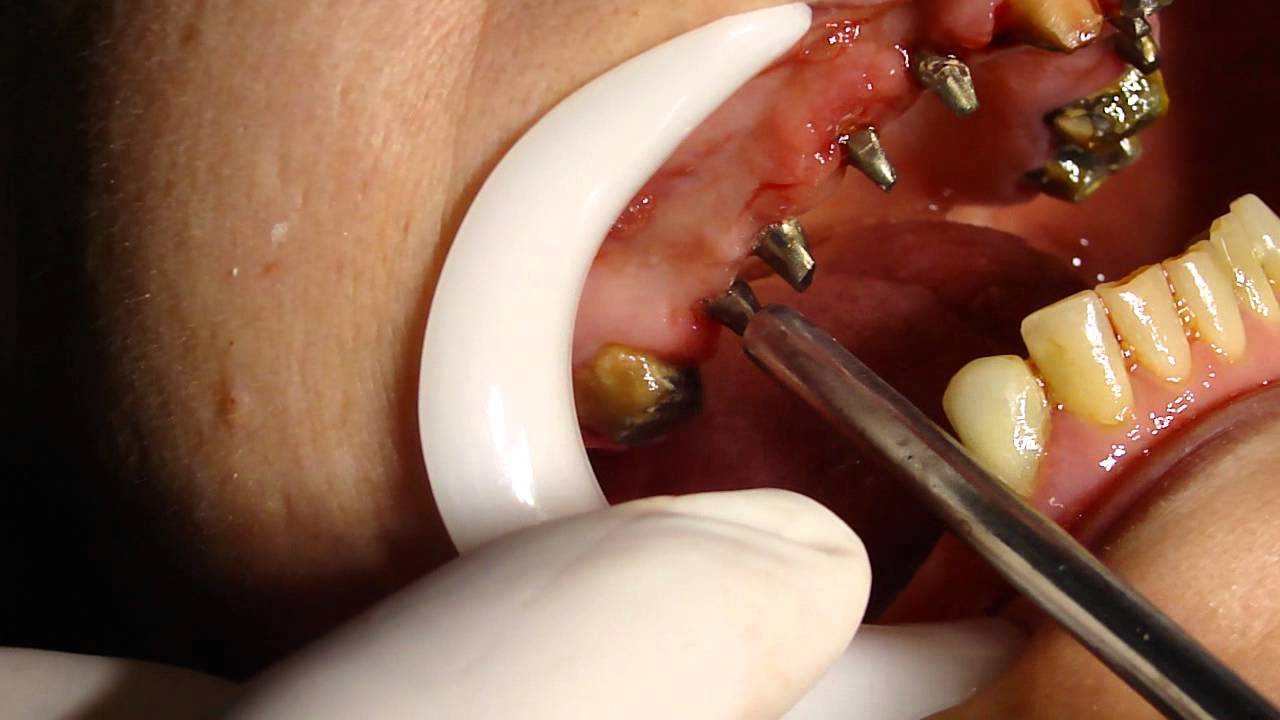 COMO SABER SI UN IMPLANTE DENTAL ESTA OSEOINTEGRADO O NO