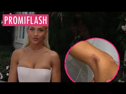 Video Thumbnail: Tammy Hembrow zeigt Hautkrebsnarbe und warnt vor der Sonne