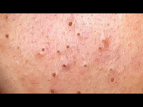 SATISFYING BLACKHEAD REMOVAL – Viewer Be Warned