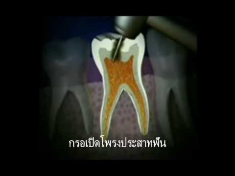 Prednisolone โรคสะเก็ดเงินครีม พืช celandine สำหรับโรคสะเก็ดเงิน