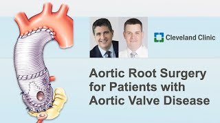 Download lagu Valve Sparing Aortic Root Replacement: Surgeon Roundtable with Dr. Roselli and Dr. Koprivanac mp3