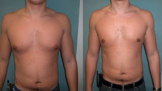 how to get rid of gynecomastia during puberty