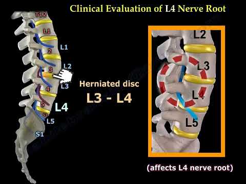 Evaluación de las raíces de los nervios lumbares: diagnóstico de hernias de disco y lesiones nerviosas