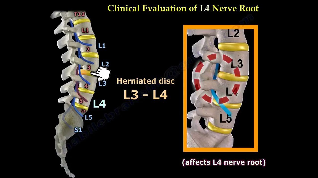 Neurological Evaluation Of The Lumbar Nerve Roots. Diagnoses of a herniated disc, nerve root injury.