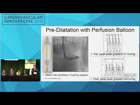CVI2018 Session: Complex valve-in-valve therapy - Chad Kliger, MD