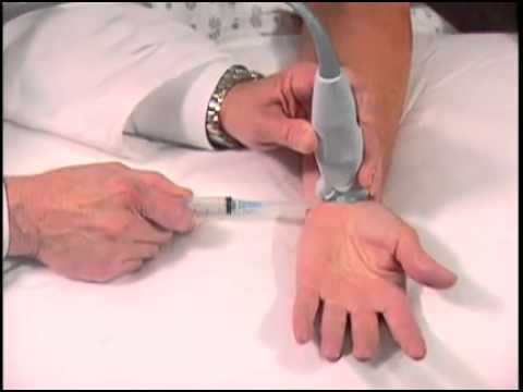 How To: Ultrasound Guided Carpal Tunnel Injection 3D Video