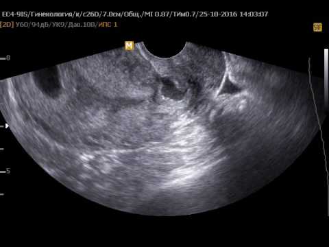 Операция рубца на матке. Беременность в рудиментарном Роге матки УЗИ. Несостоятельный рубец на матке.