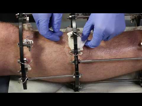 NHSGGC - GRI Pin Site Dressings Guidance