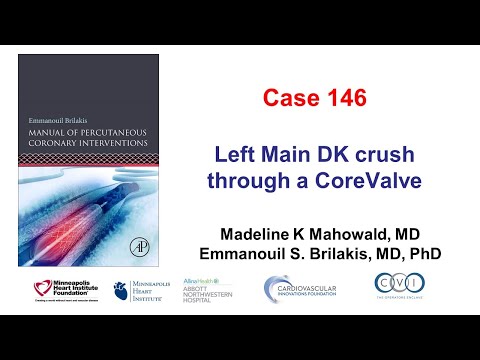 Case 146: PCI Manual - DK crush through a CoreValve