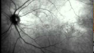 Eye Floaters Video