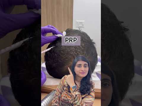 Hair loss treatments| PRP for hair loss| GFC treatment | #hairloss