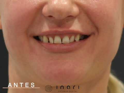 Carillas Dentales de Porcelana II
