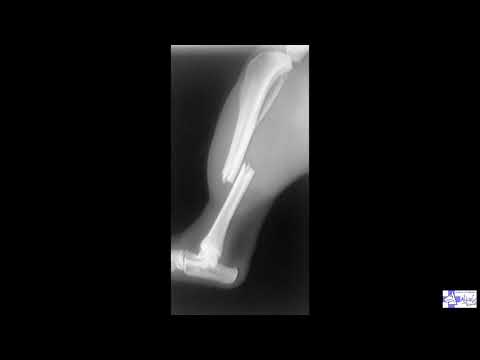 MARVEL.Fractura de tibia y peroné