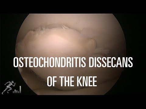 térd osteochondrozisának kezelésére