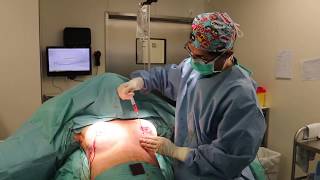 Operación de Mama Tuberosa