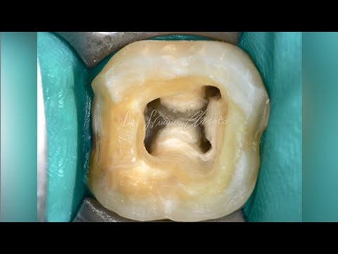 Management Of Calcified Canals