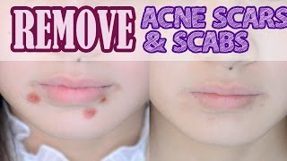 How to: Remove Acne Scars &amp; Scabs