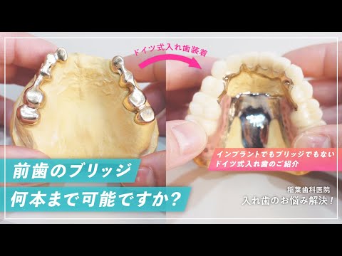 前歯のブリッジ何本まで可能ですか？〜インプラントでもブリッジでもない、ドイツ式入れ歯のご紹介〜