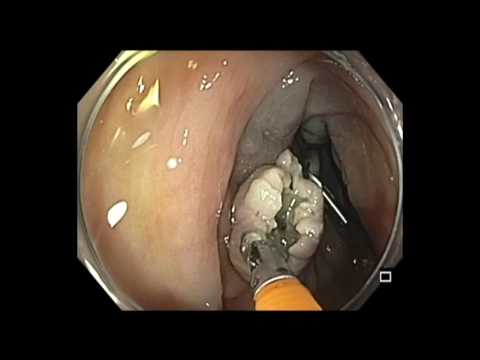 Colonoscopy: Ascending Colon Flat Lesion EMR