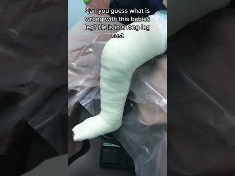 Long leg cast on a baby