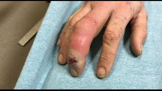severe finger infection