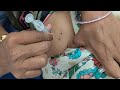 IM Injection Veyadam Ela All Type Of Female Injection Trending Doctor Hip Buttock Injection Arm