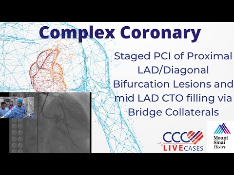 PCI of Proximal LAD/Diagonal Bifurcation Lesions & mid LAD CTO filling w Bridge Collaterals May 2014